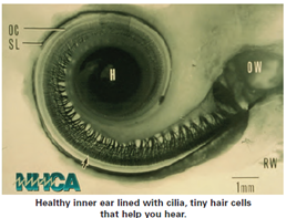 Microscopic view of a healthy inner ear, showing cilia and tiny hair cells involved in hearing.